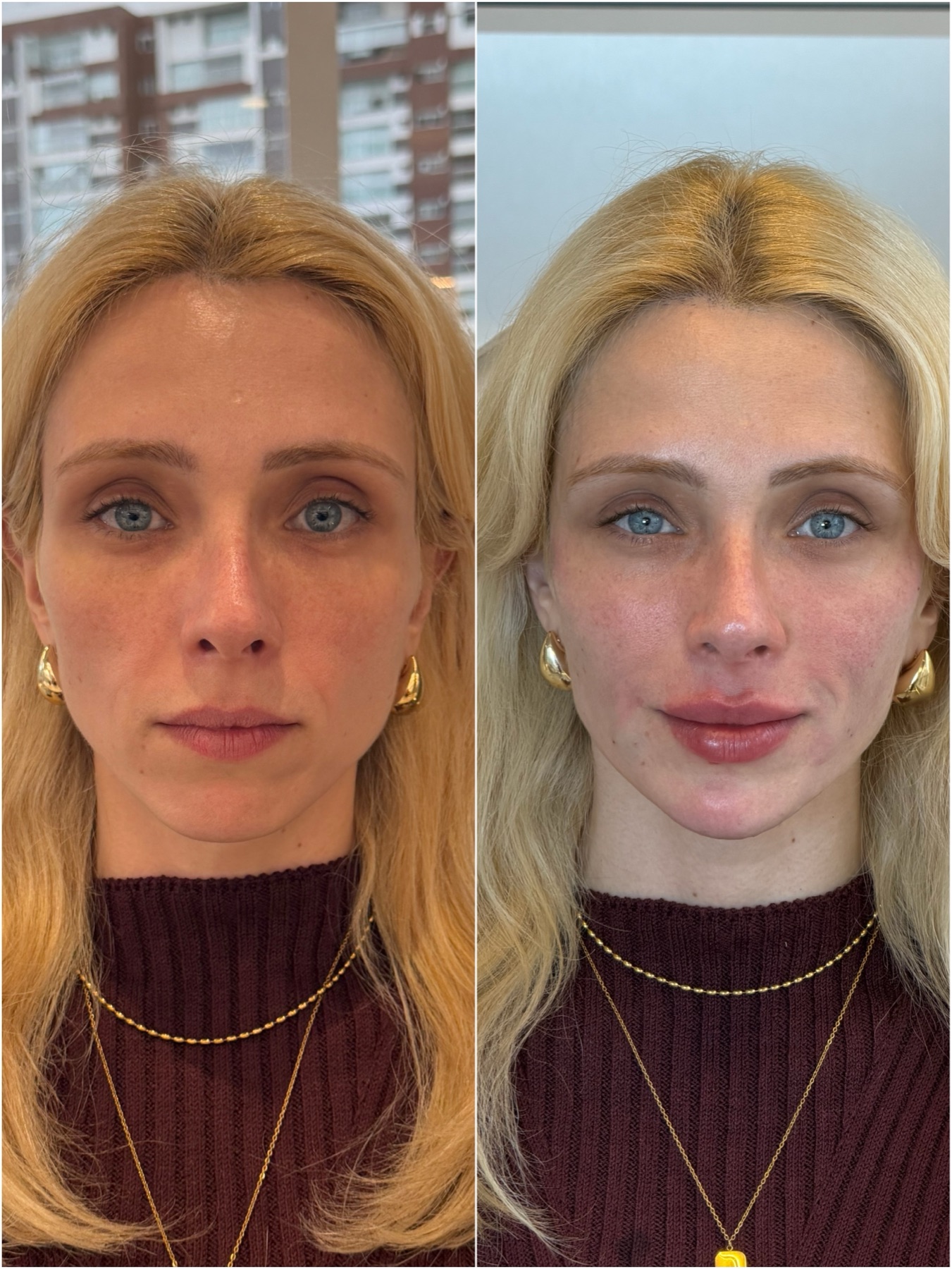 Resultado de harmonização facial na RUV — antes e depois