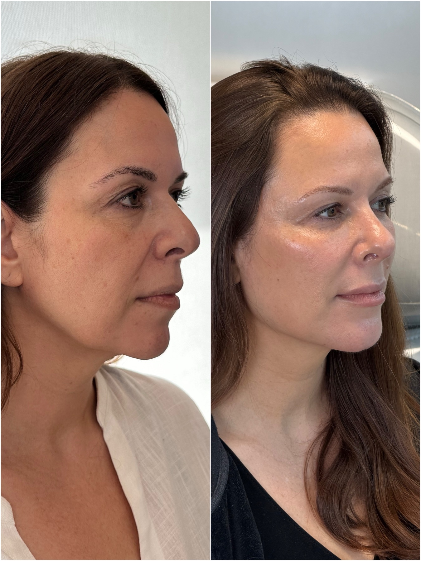 Resultado de harmonização facial na RUV — antes e depois