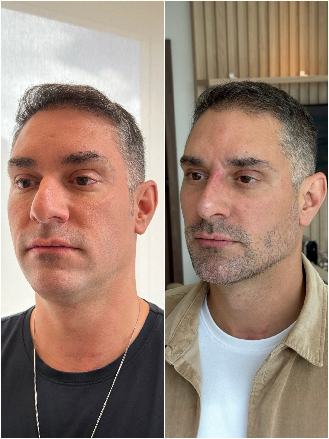 Resultado de harmonização facial na RUV — antes e depois