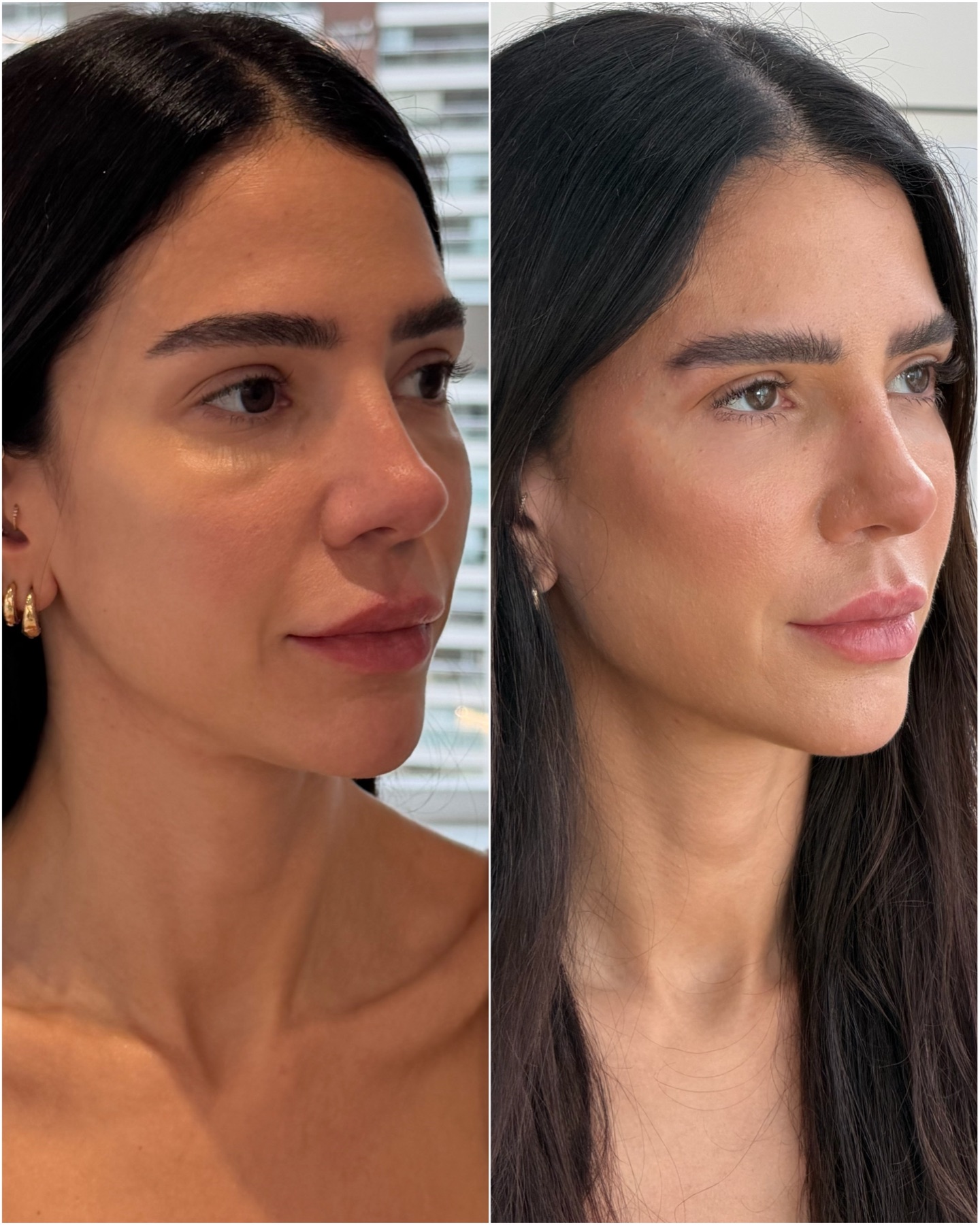 Resultado de harmonização facial na RUV — antes e depois