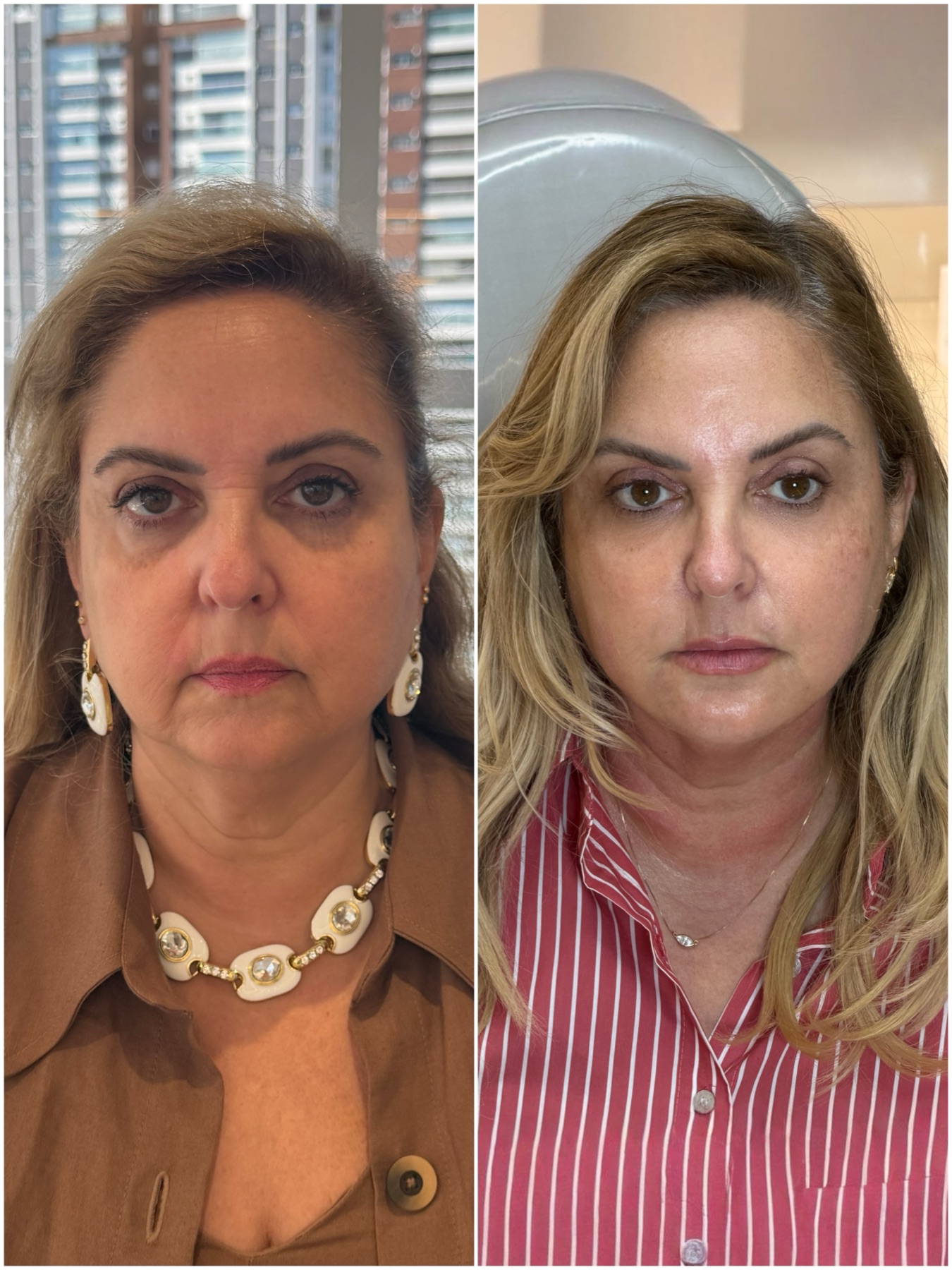 Resultado de harmonização facial na RUV — antes e depois