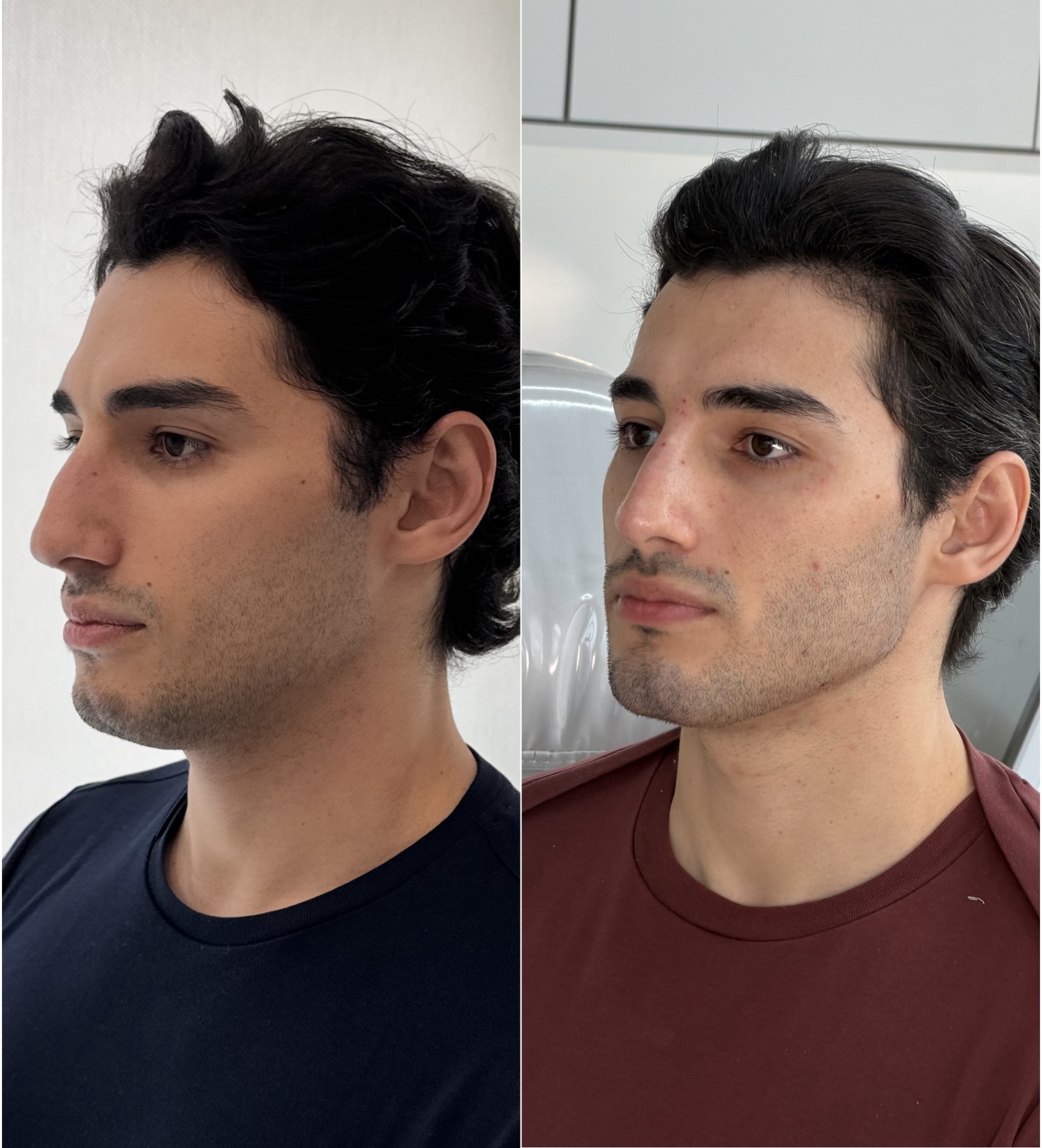 Resultado de harmonização facial na RUV — antes e depois