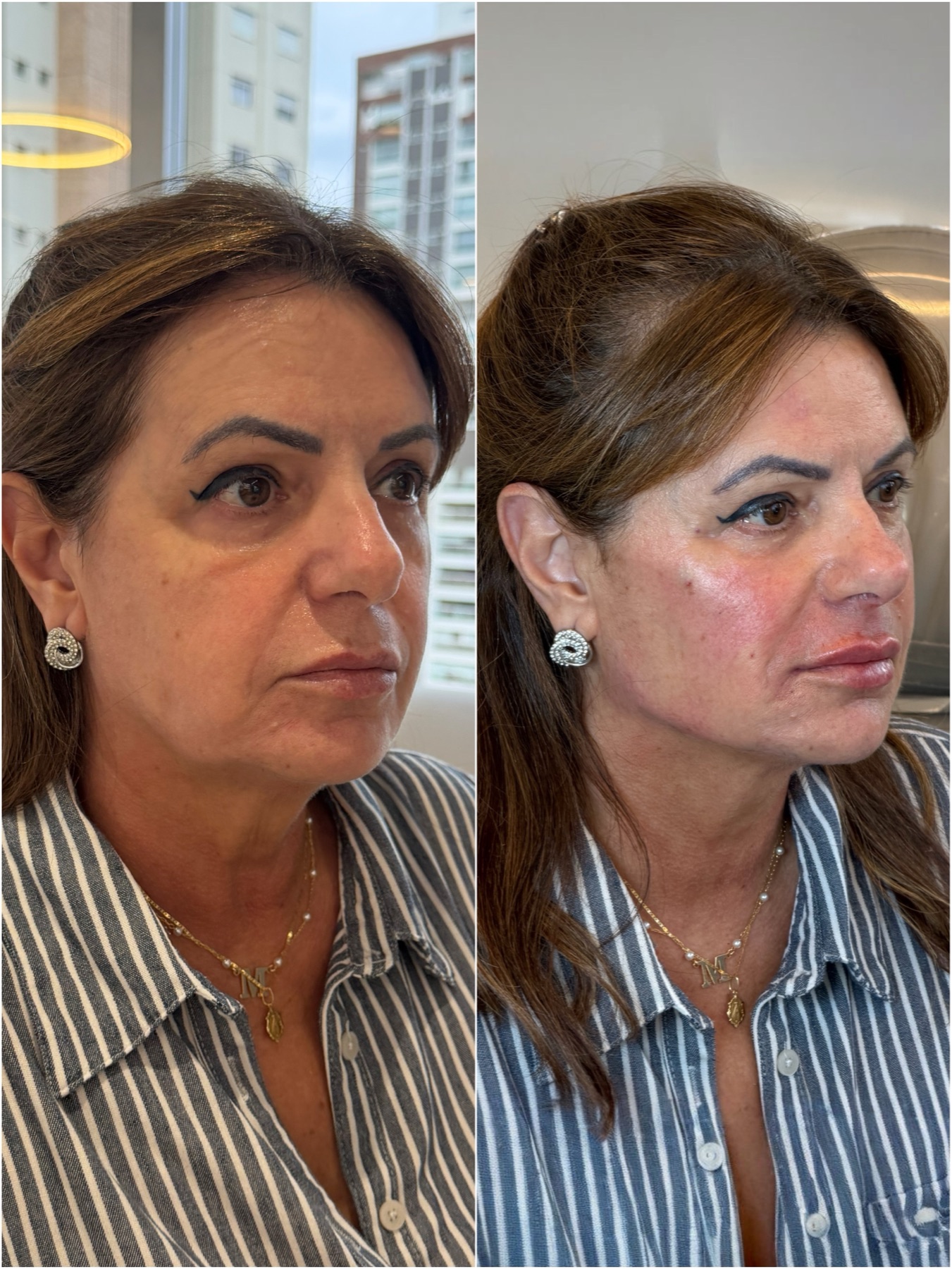 Resultado de harmonização facial na RUV — antes e depois