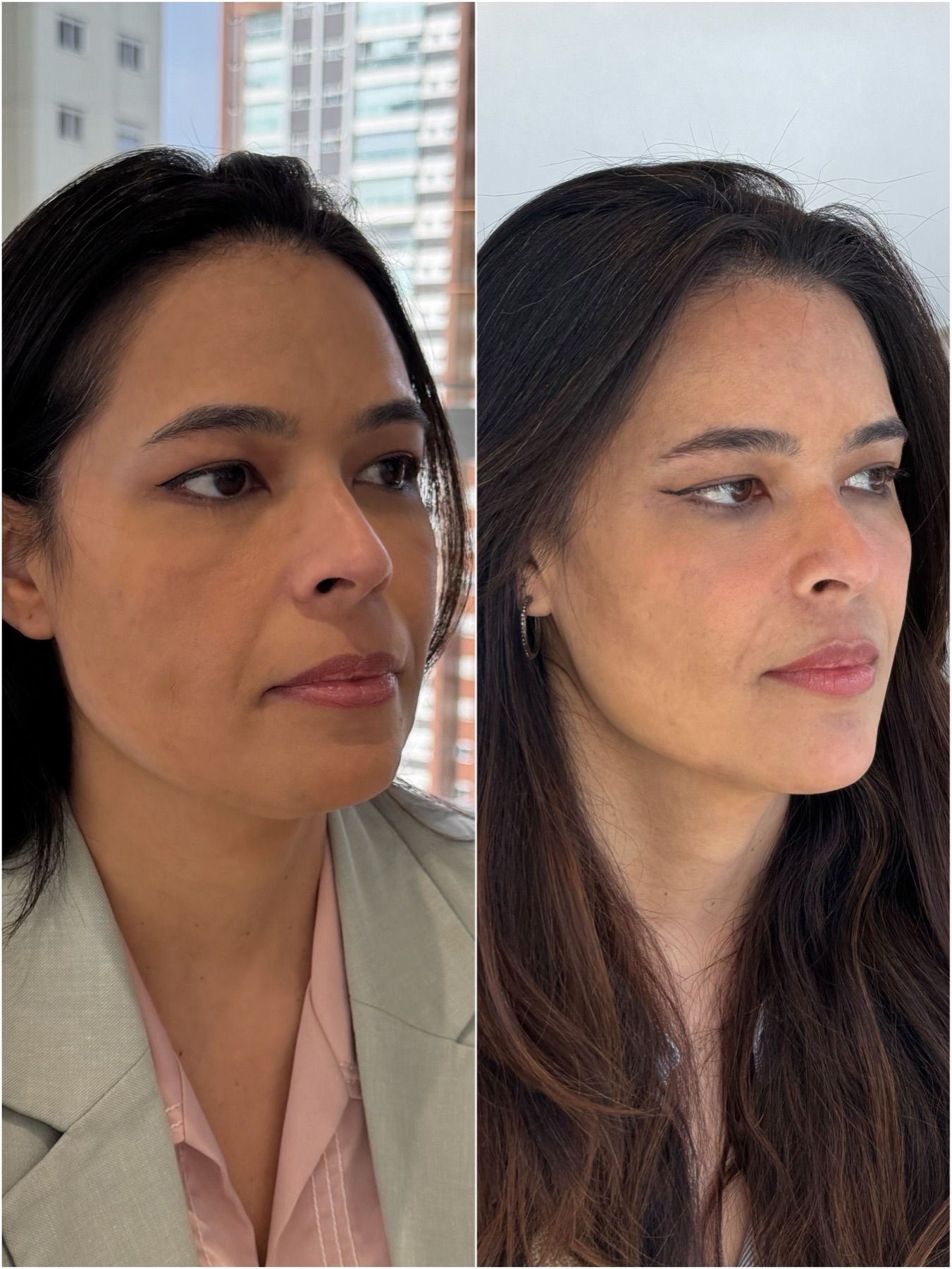 Resultado de harmonização facial na RUV — antes e depois