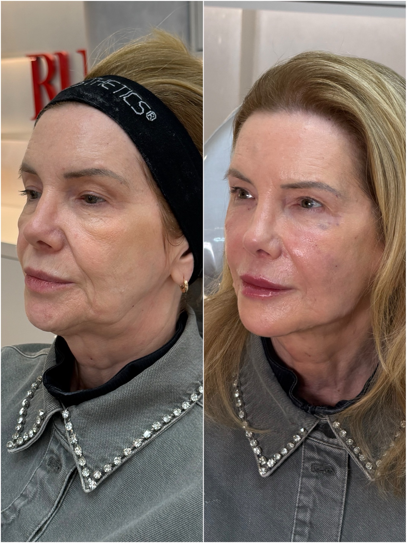 Resultado de harmonização facial na RUV — antes e depois
