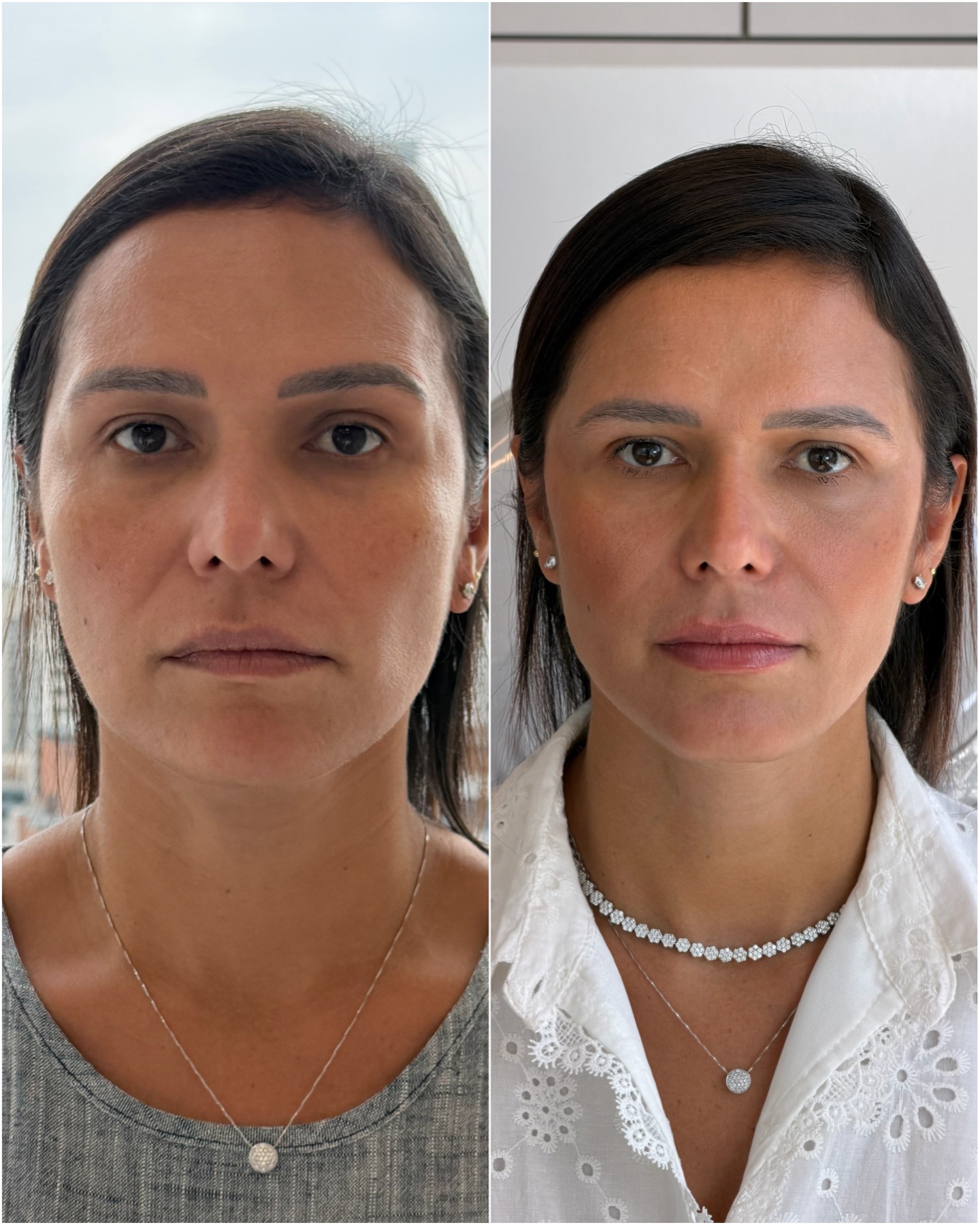 Resultado de harmonização facial na RUV — antes e depois
