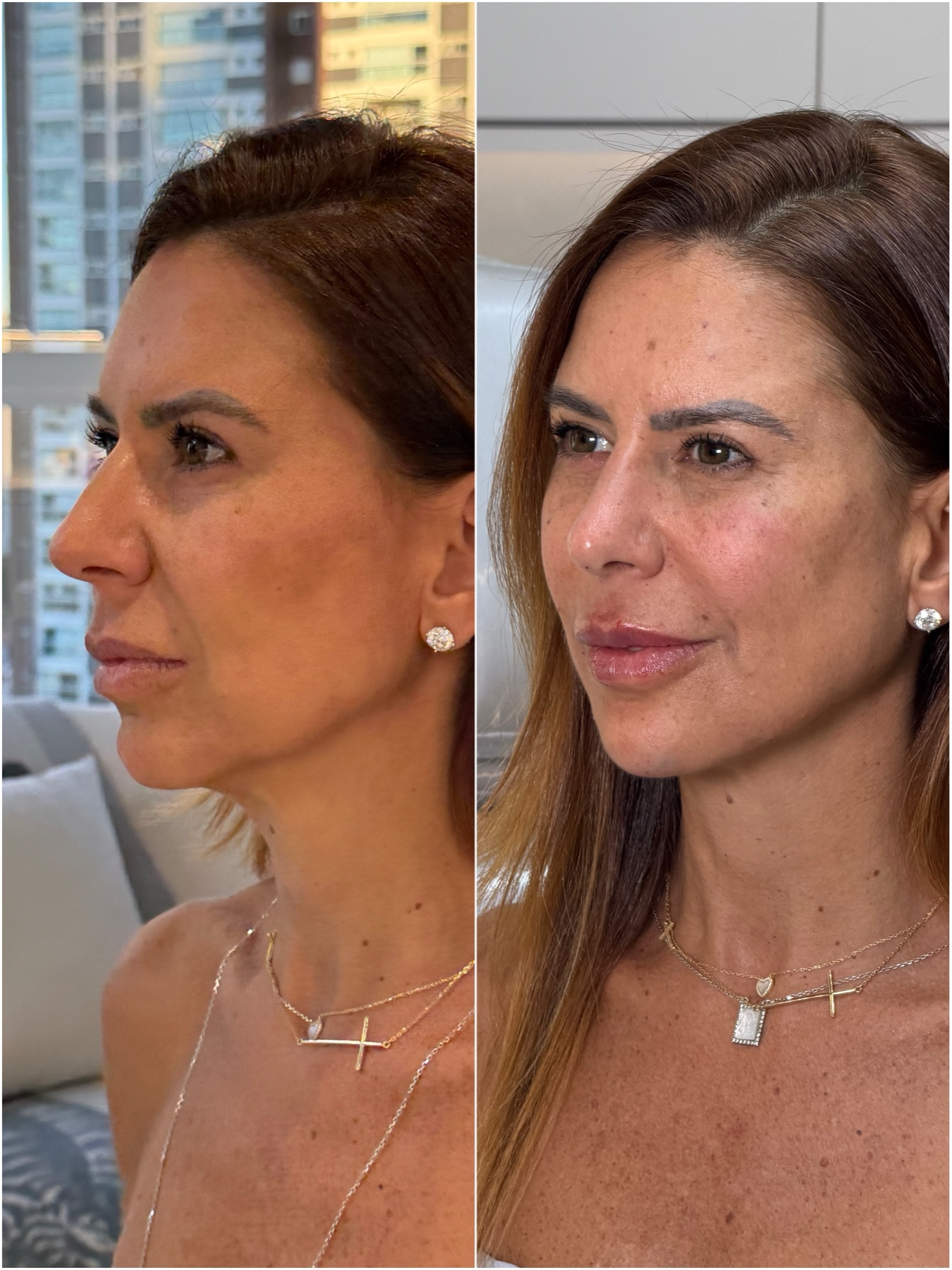 Resultado de harmonização facial na RUV — antes e depois