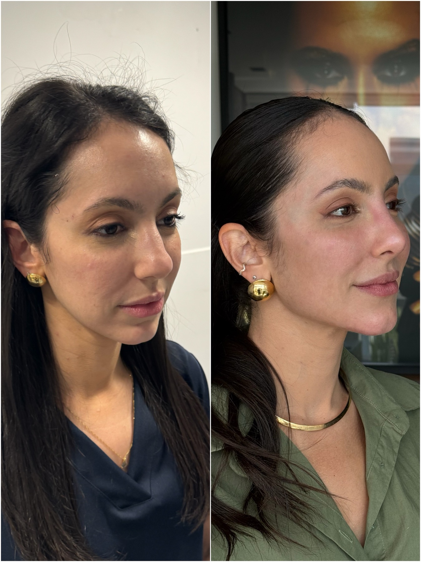 Resultado de harmonização facial na RUV — antes e depois