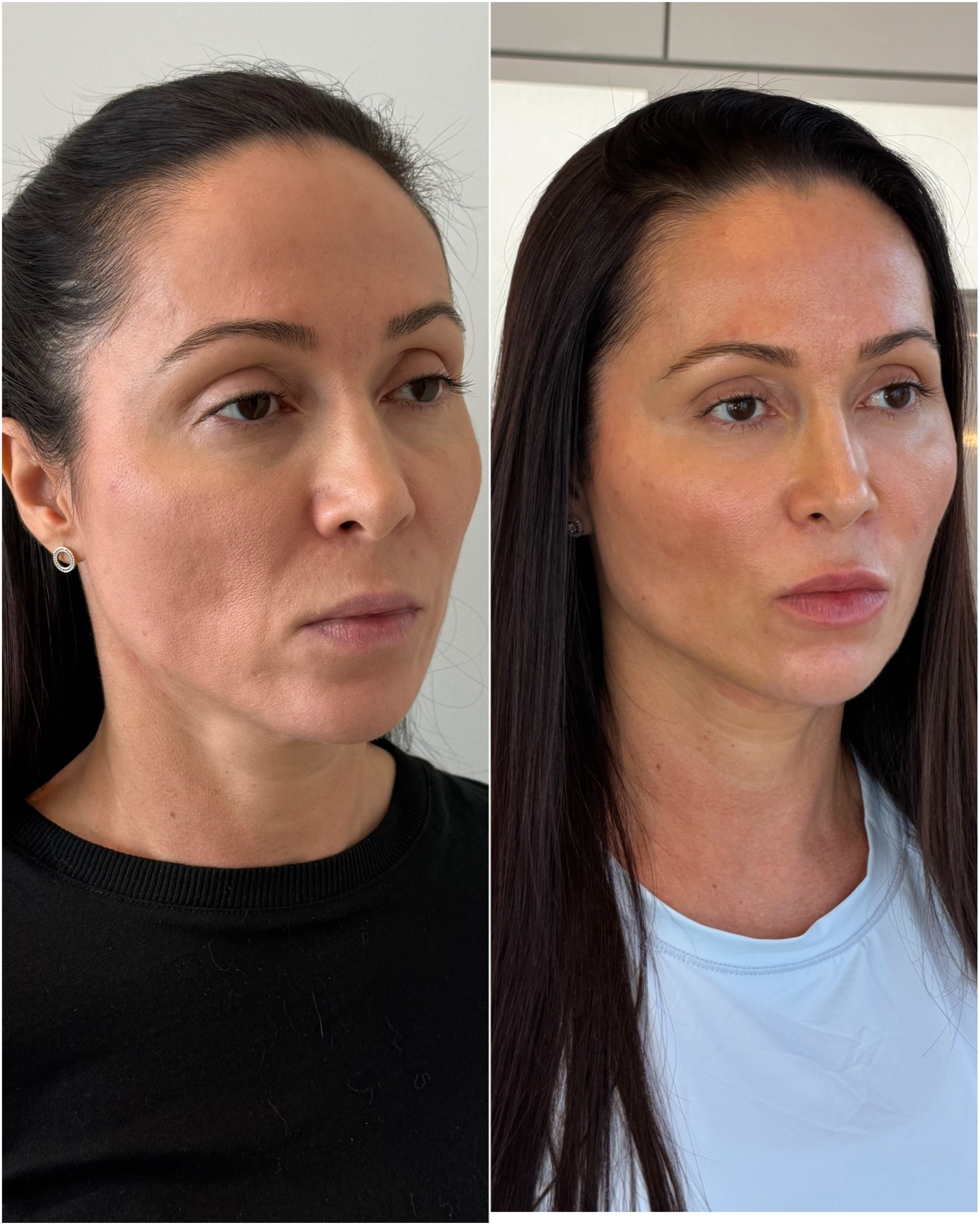 Resultado de harmonização facial na RUV — antes e depois