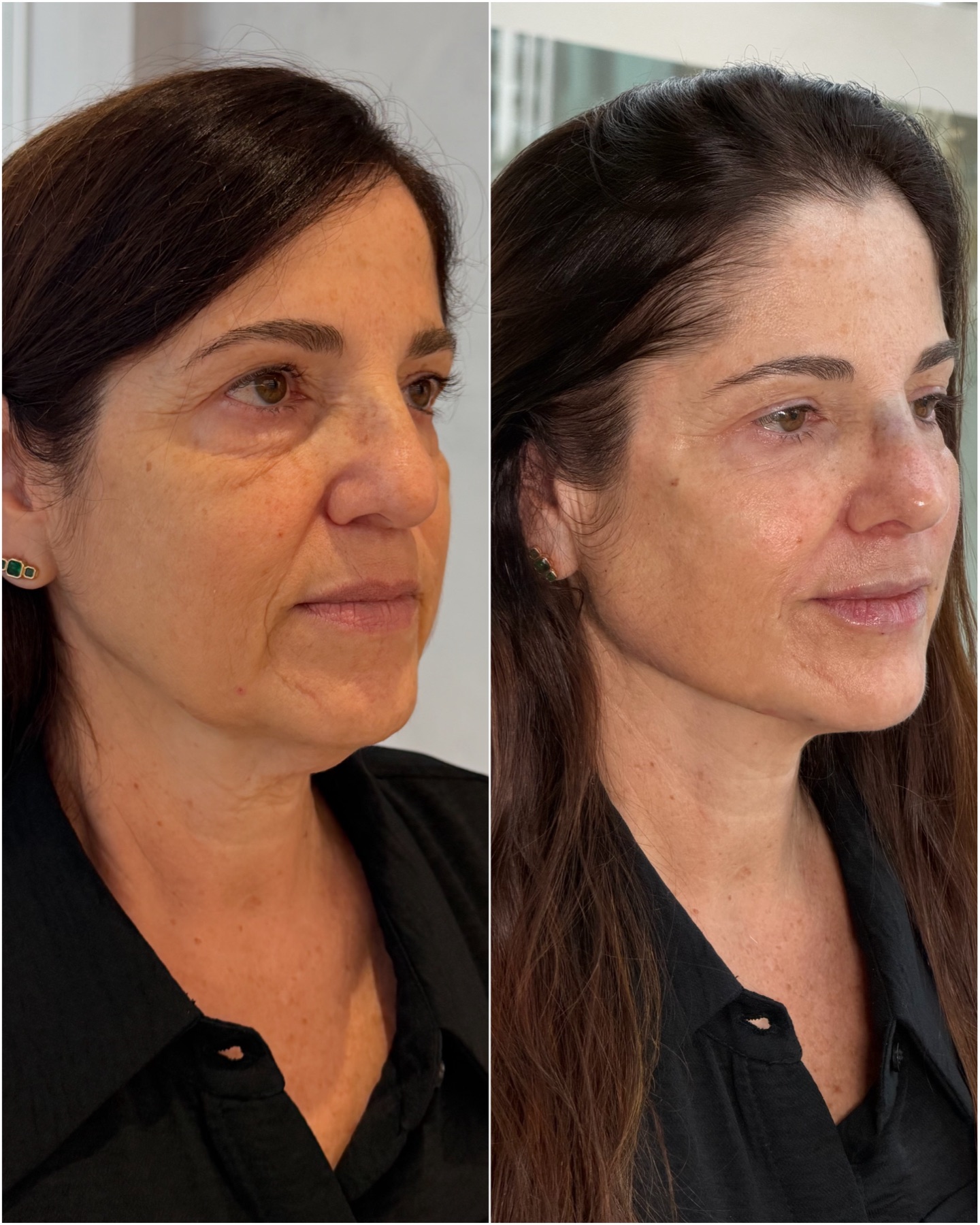 Resultado de harmonização facial na RUV — antes e depois
