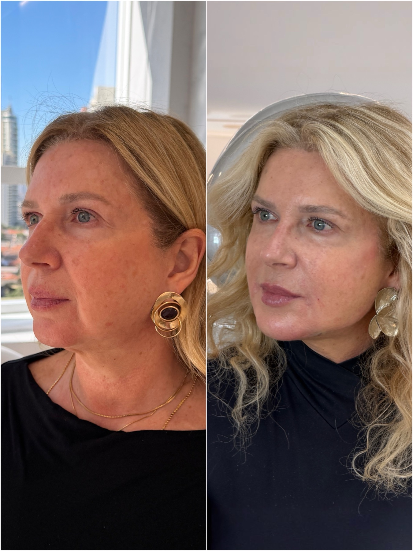 Resultado de harmonização facial na RUV — antes e depois