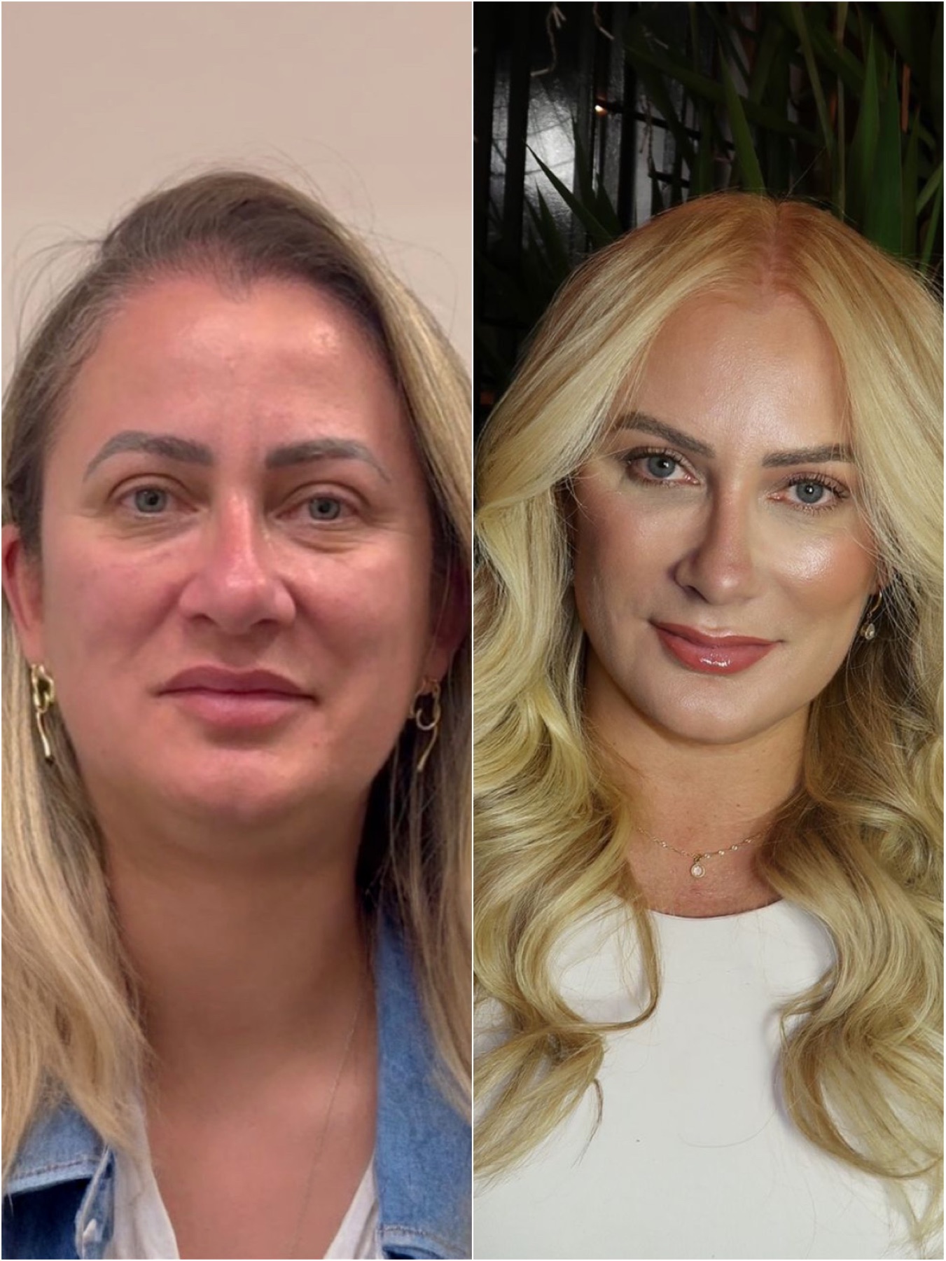 Resultado de harmonização facial na RUV — antes e depois